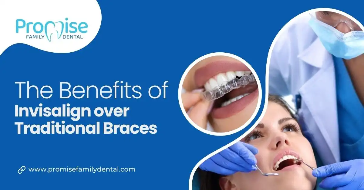 The Benefits of Invisalign over Traditional Braces