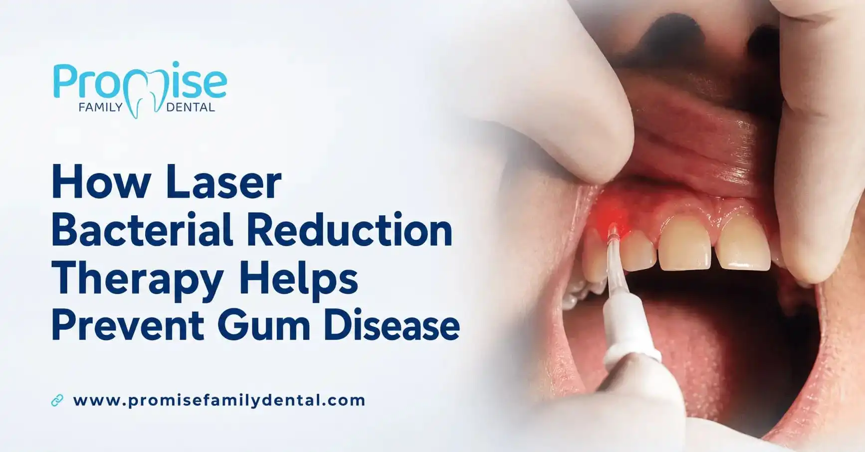 How Laser Bacterial Reduction Therapy Improves Routine Dental Cleanings and Helps Prevent Gum Disease