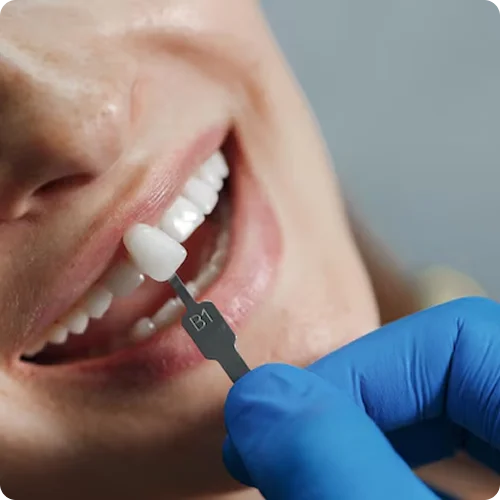 Dental Implants image