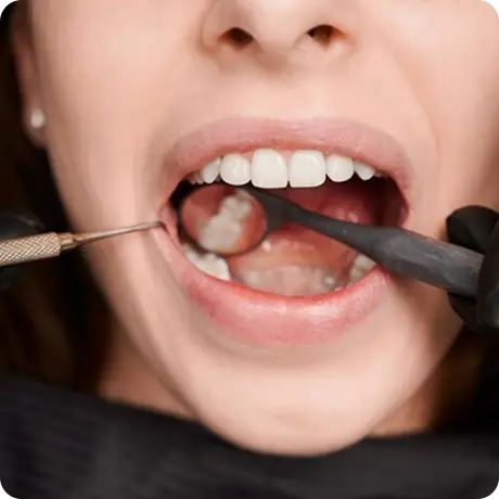 tooth extraction image